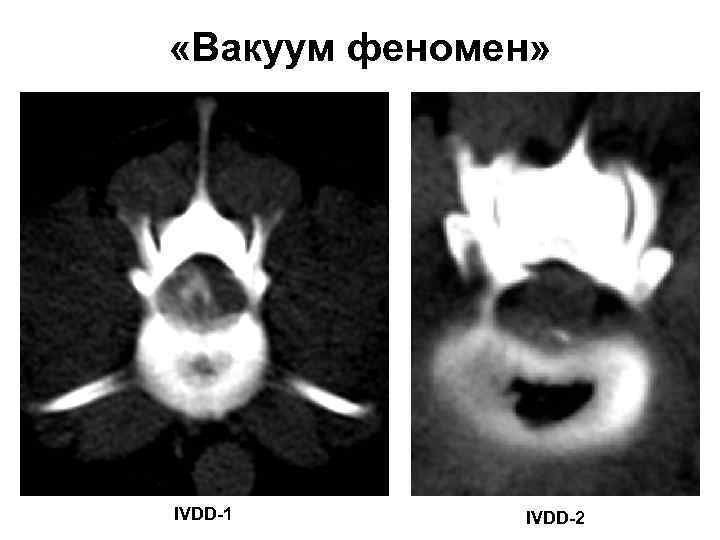  «Вакуум феномен» IVDD-1 IVDD-2 