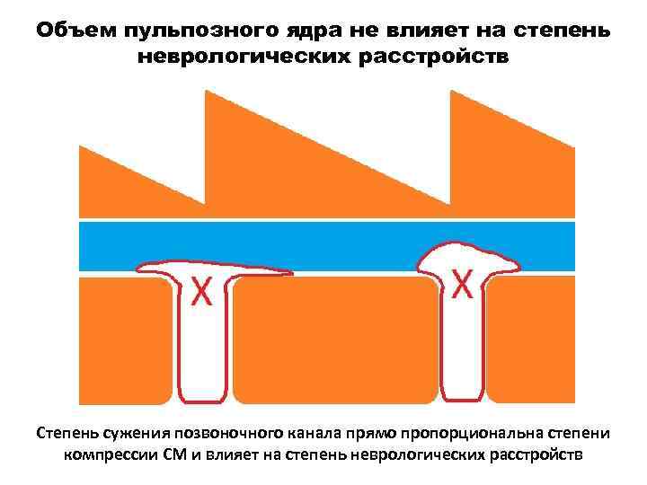 Объем пульпозного ядра не влияет на степень неврологических расстройств Степень сужения позвоночного канала прямо