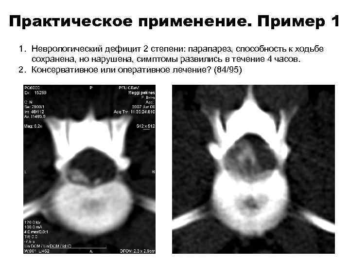 Практическое применение. Пример 1 1. Неврологический дефицит 2 степени: парапарез, способность к ходьбе сохранена,