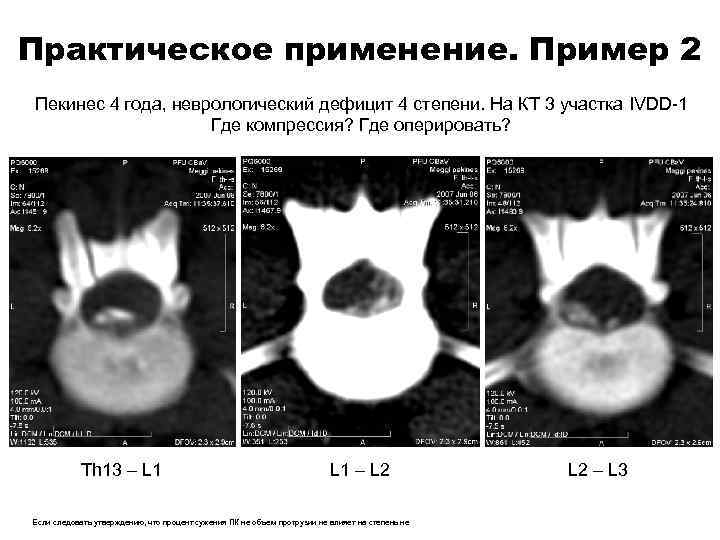 Практическое применение. Пример 2 Пекинес 4 года, неврологический дефицит 4 степени. На КТ 3