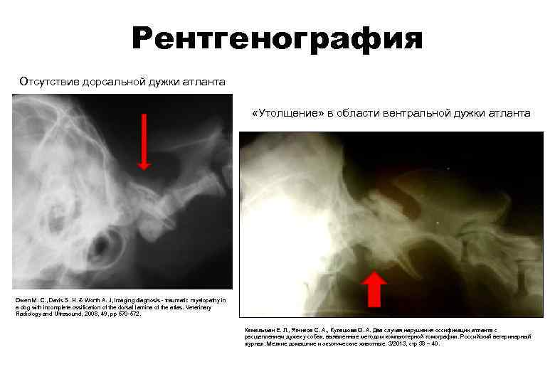Рентгенография Отсутствие дорсальной дужки атланта «Утолщение» в области вентральной дужки атланта Owеn М. С.