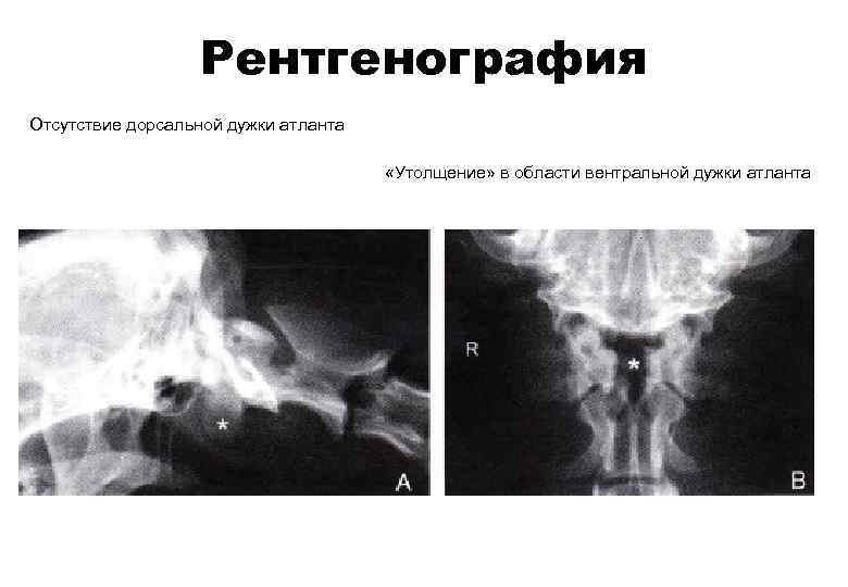 Рентгенография Отсутствие дорсальной дужки атланта «Утолщение» в области вентральной дужки атланта 