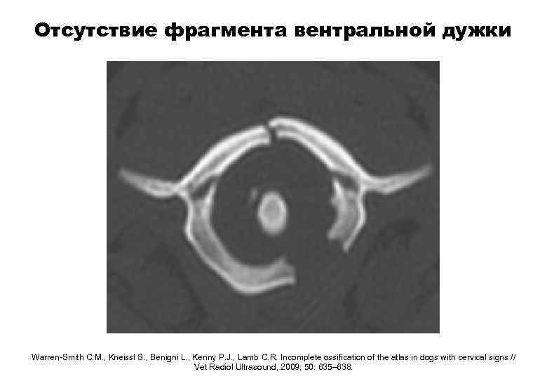 Отсутствие фрагмента вентральной дужки Warren-Smith C. M. , Kneissl S. , Benigni L. ,