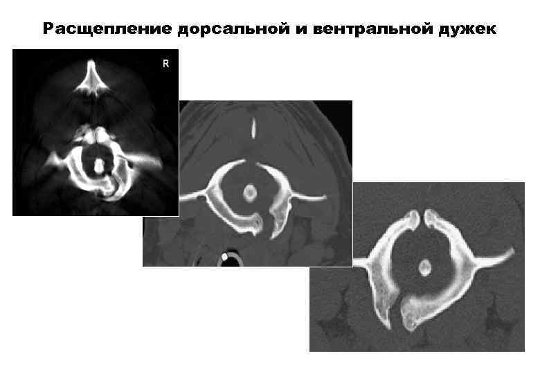 Вентральная грыжа фото до и после