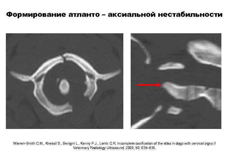 Формирование атланто – аксиальной нестабильности Warren-Smith C. M. , Kneissl S. , Benigni L.