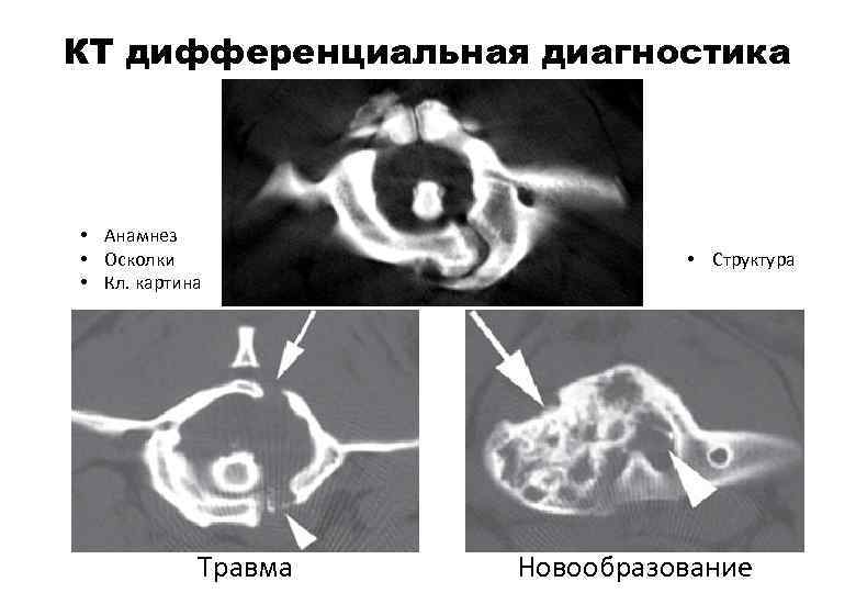 Кт картина ротационного подвывиха атланта