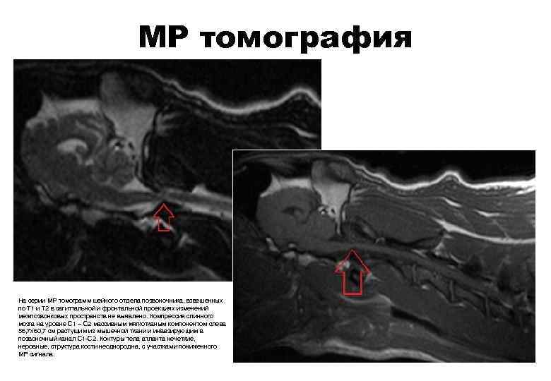 МР томография На серии МР томограмм шейного отдела позвоночника, взвешенных по Т 1 и