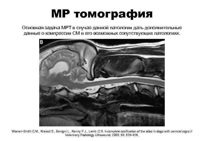 МР томография Основная задача МРТ в случае данной патологии дать дополнительные данные о компрессии