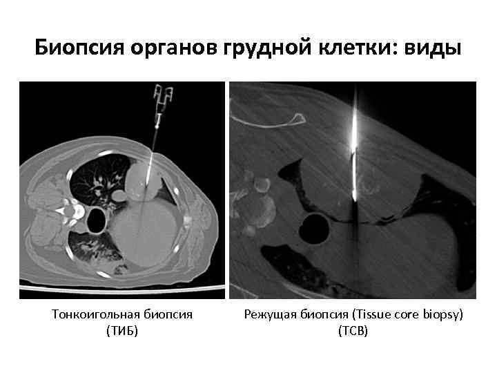 Биопсия органов грудной клетки: виды Тонкоигольная биопсия (ТИБ) Режущая биопсия (Tissue core biopsy) (TCB)