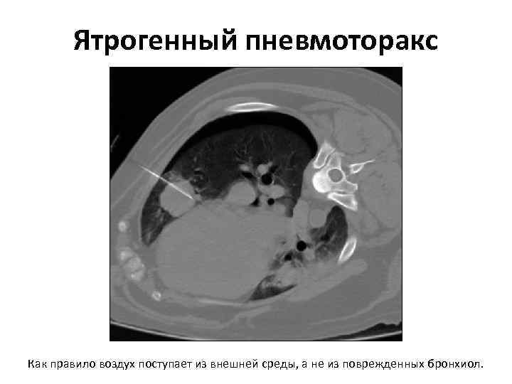 Ятрогенный пневмоторакс Как правило воздух поступает из внешней среды, а не из поврежденных бронхиол.