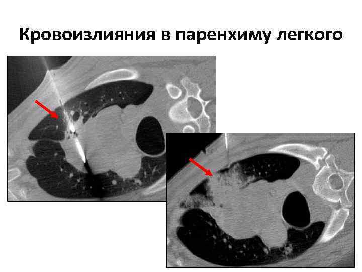 Кровоизлияния в паренхиму легкого 