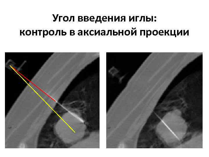 Угол введения иглы: контроль в аксиальной проекции 