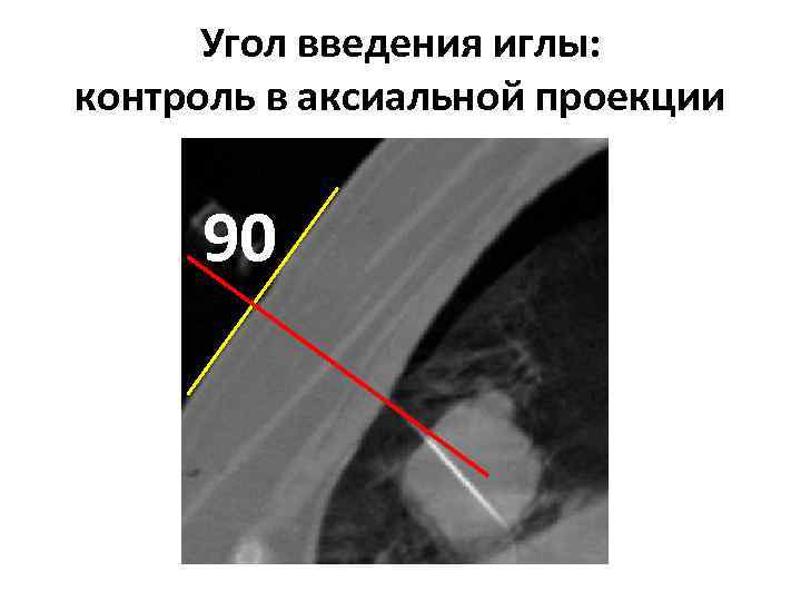 Угол введения иглы: контроль в аксиальной проекции 90 