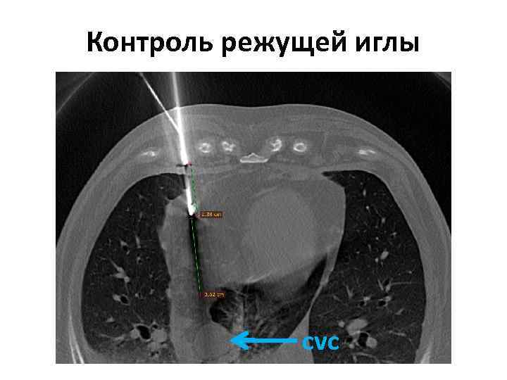 Контроль режущей иглы cvc 