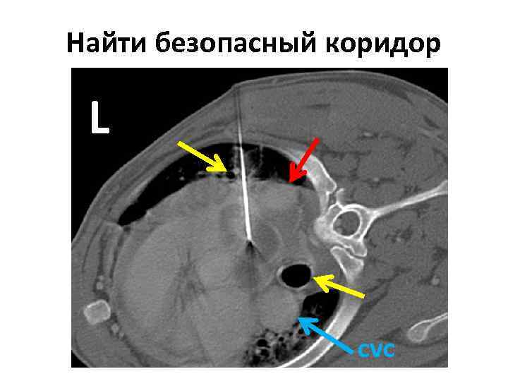 Найти безопасный коридор L cvc 