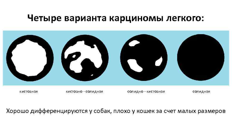 Четыре варианта карциномы легкого: кистозная кистозно - солидная солидно - кистозная солидная Хорошо дифференцируются