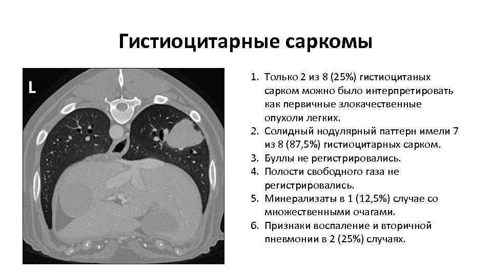 Гистиоцитарные саркомы 1. Только 2 из 8 (25%) гистиоцитаных сарком можно было интерпретировать как