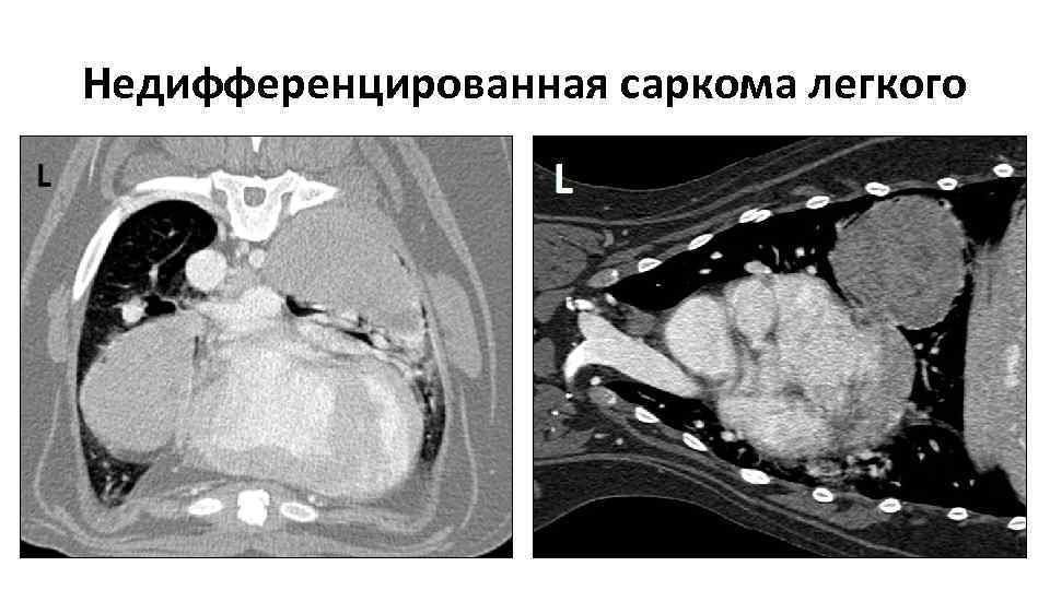 Недифференцированная саркома легкого 