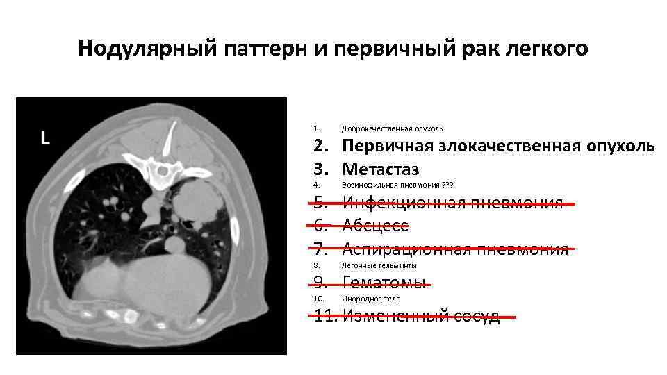 Перифиссуральные узелки в легких на кт