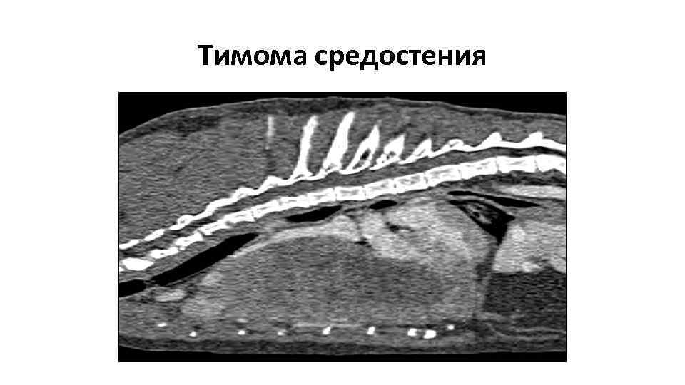 Тимома средостения 