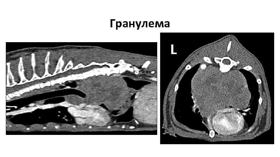 Гранулема 