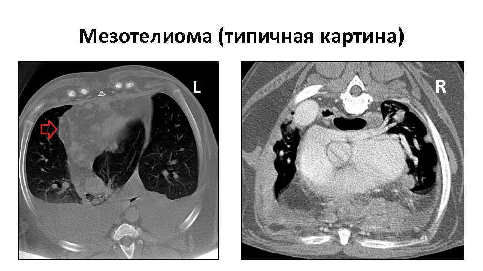 Мезотелиома (типичная картина) 