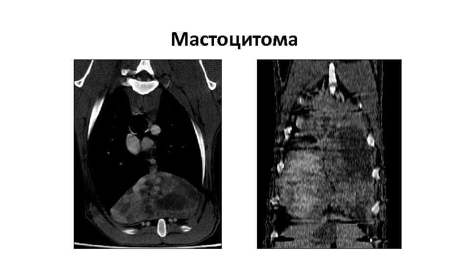 Мастоцитома 