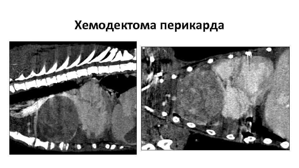 Хемодектома перикарда 