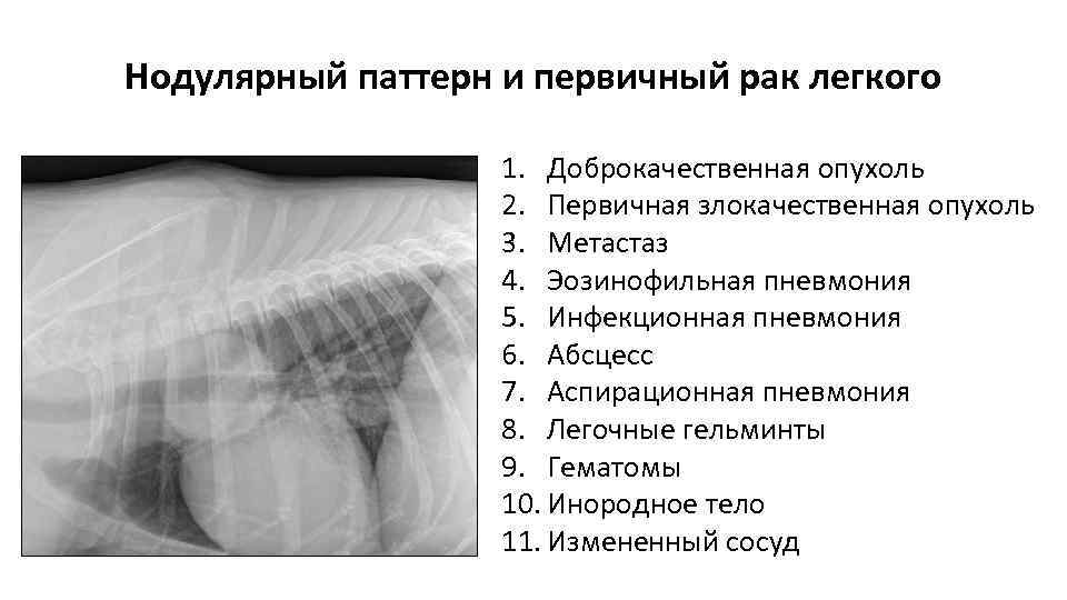 Нодулярный паттерн и первичный рак легкого 1. Доброкачественная опухоль 2. Первичная злокачественная опухоль 3.