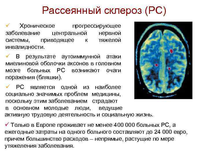 Рассеянный склероз (РС) ü Хроническое прогрессирующее заболевание центральной нервной системы, приводящее к тяжелой инвалидности.