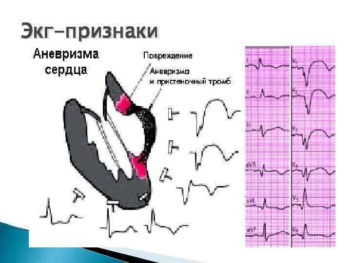 Нижняя стенка левого желудочка. ЭКГ при аневризме левого желудочка ЭКГ. ЭКГ при аневризме лж. Аневризма левого желудочка на ЭКГ. Аневризма желудочка сердца на ЭКГ.