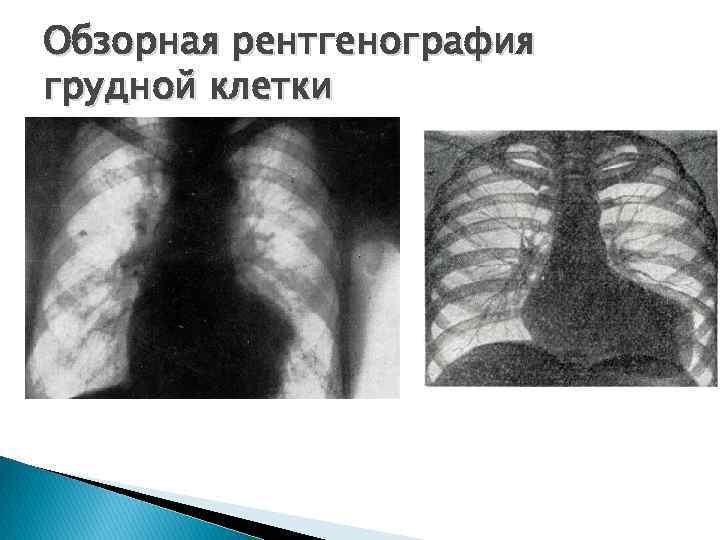 Обзорная рентгенография грудной клетки 