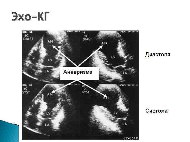После эхо. Аневризма левого желудочка на УЗИ. Аневризма левого желудочка на ЭХОКГ.
