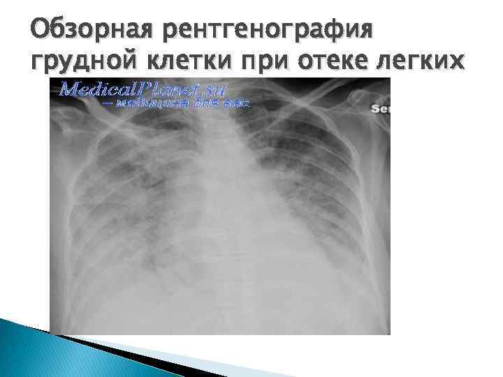 Обзорная рентгенография грудной клетки при отеке легких 