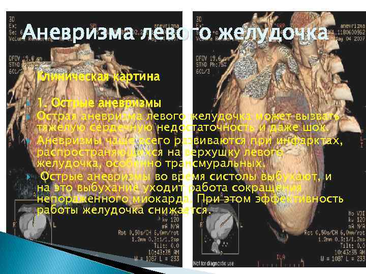 Аневризма левого желудочка Клиническая картина 1. Острые аневризмы Острая аневризма левого желудочка может вызвать