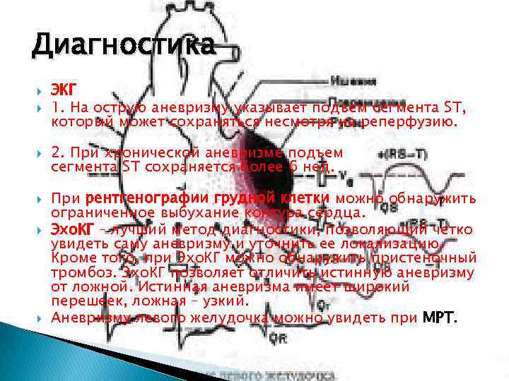 Картине истинной аневризмы в области верхушки миокарда левого желудочка соответствует