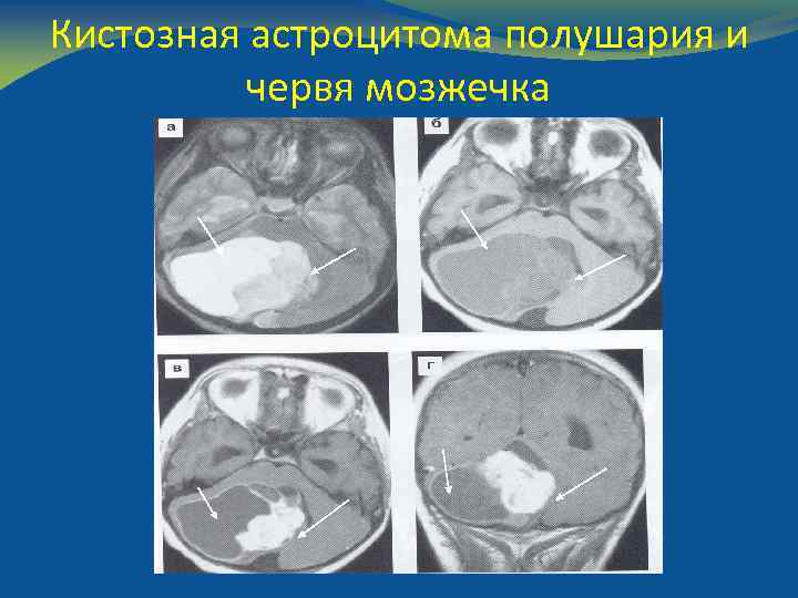 Кистозная астроцитома полушария и червя мозжечка 