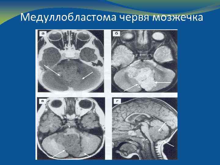 Медуллобластома червя мозжечка 