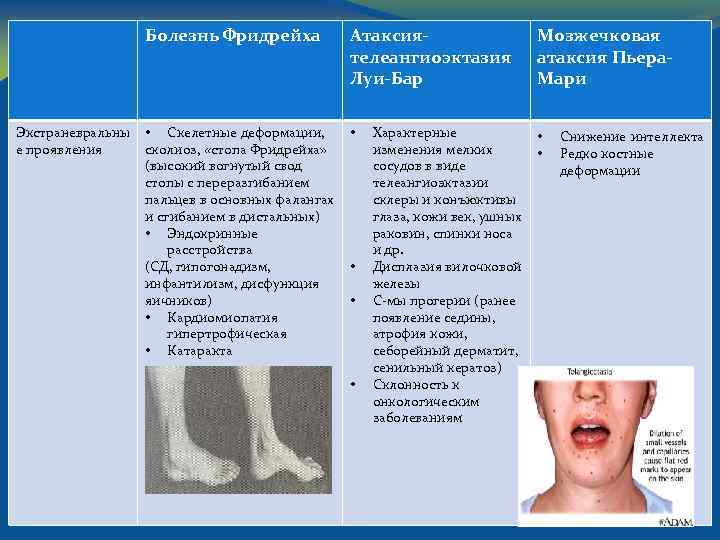 Болезнь фридрейха презентация