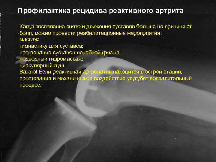 Профилактика рецидива реактивного артрита Когда воспаление снято и движения суставов больше не причиняют боли,