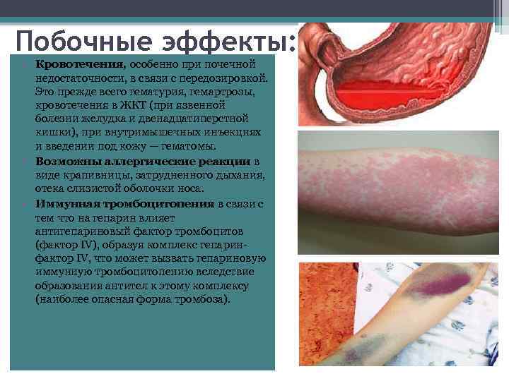Побочные эффекты: • Кровотечения, особенно при почечной недостаточности, в связи с передозировкой. Это прежде