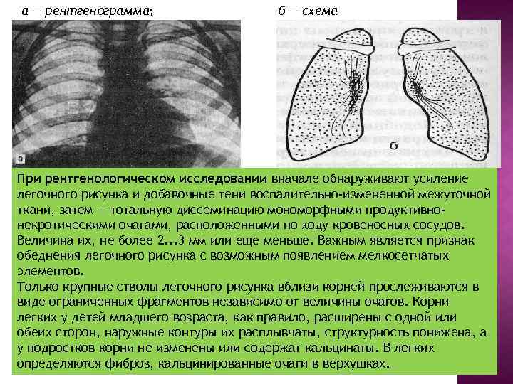 а — рентгенограмма; б — схема При рентгенологическом исследовании вначале обнаруживают усиление легочного рисунка
