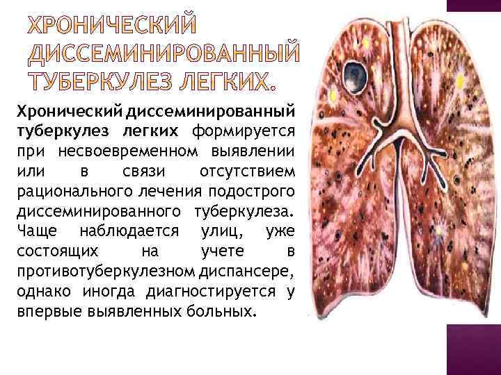 Хронический диссеминированный туберкулез легких формируется при несвоевременном выявлении или в связи отсутствием рационального лечения