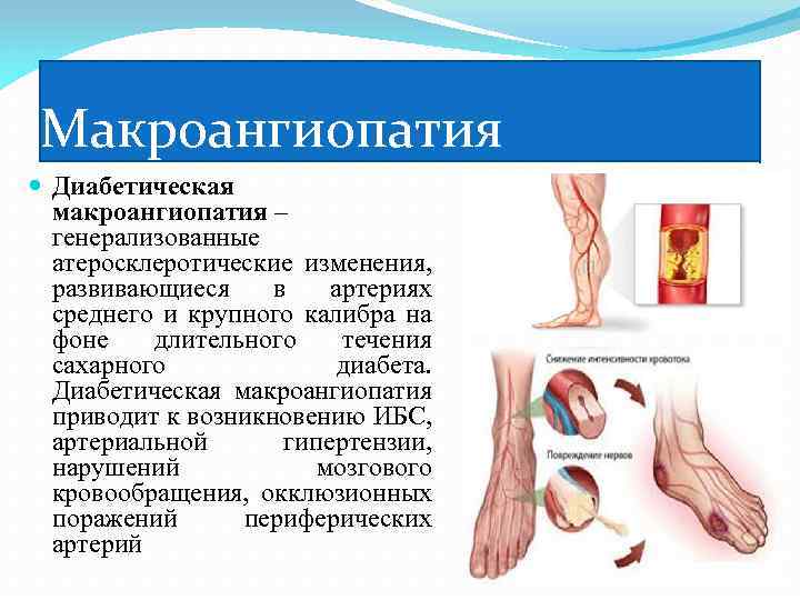 Макроангиопатия Диабетическая макроангиопатия – генерализованные атеросклеротические изменения, развивающиеся в артериях среднего и крупного калибра