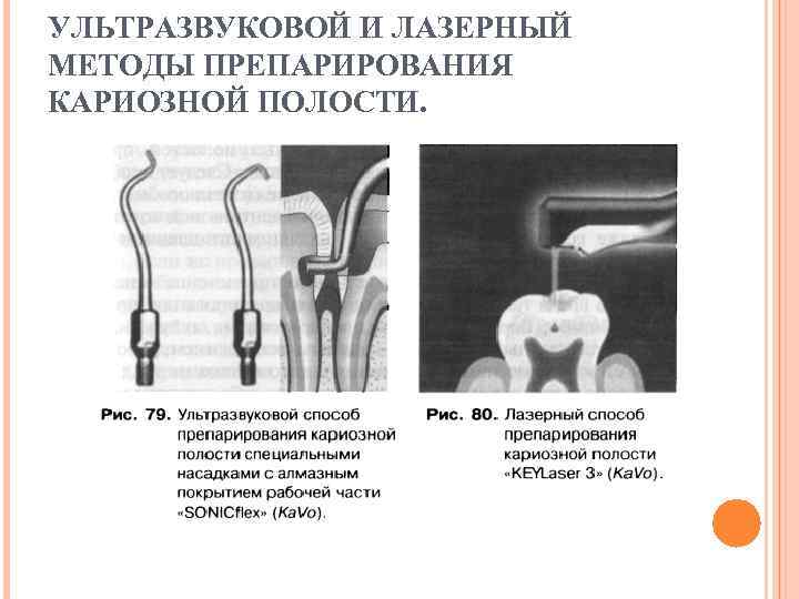 Химико механический метод препарирования кариозных полостей. Ультразвуковая обработка кариозной полости. Механический наконечник для препарирования.