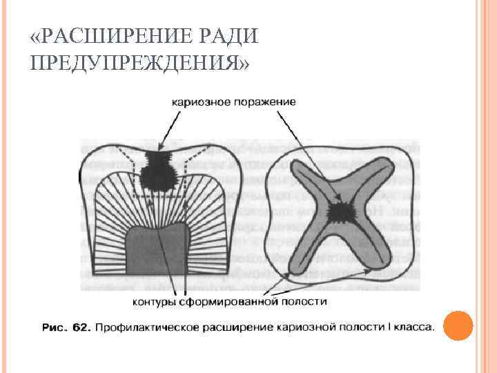 Материалы для пломбирования кариозных полостей