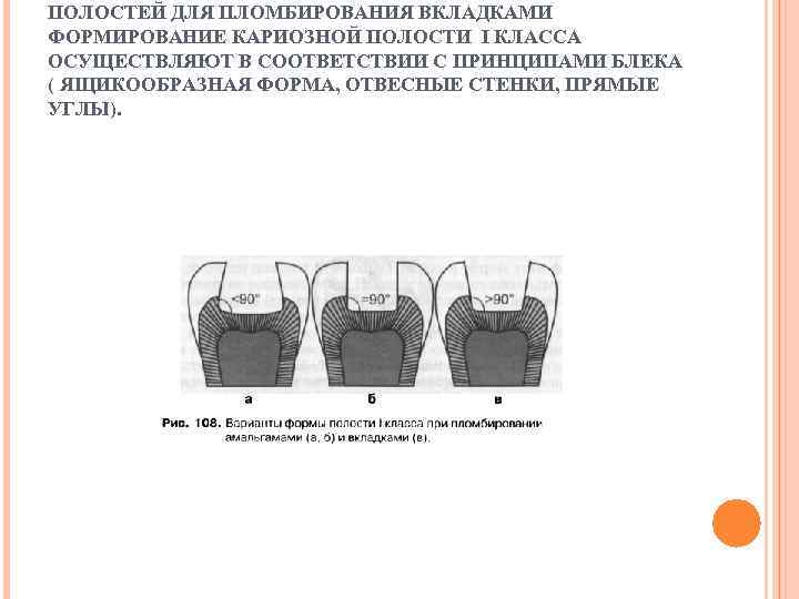 Пломбирование кариозных полостей v класса. Пломбирование кариозных полостей 1 класса. Кариозных полостей под вкладки. (I - V классов). 1. Препарирование и пломбирование кариозных полостей v класса. Основные принципы формирования полостей под вкладки.