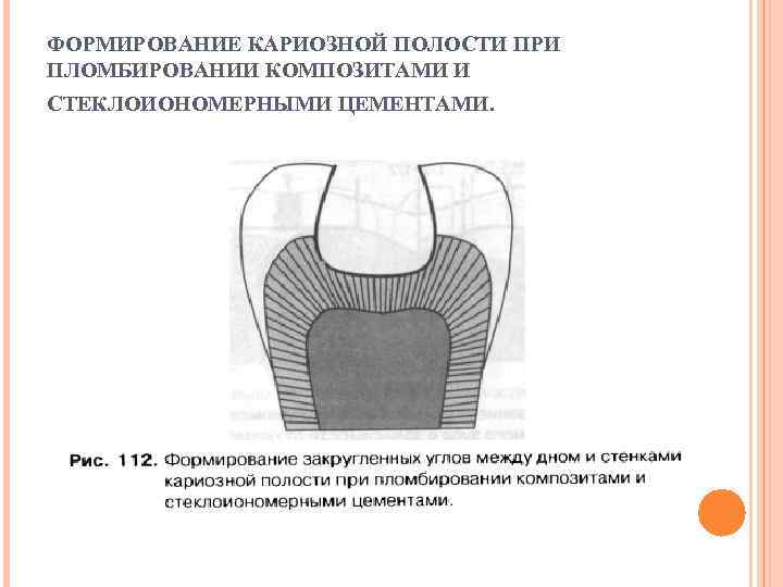 Пломбирование кариозных полостей v класса. Пломбирование кариозных полостей 1 класса композиционным материалом. Формирование дна при глубоких полостей 1 класса. Формирование дна кариозной полости. Корытообразное дно глубокой кариозной полости i класса..