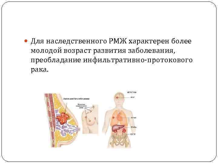  Для наследственного РМЖ характерен более молодой возраст развития заболевания, преобладание инфильтративно‑протокового рака. 