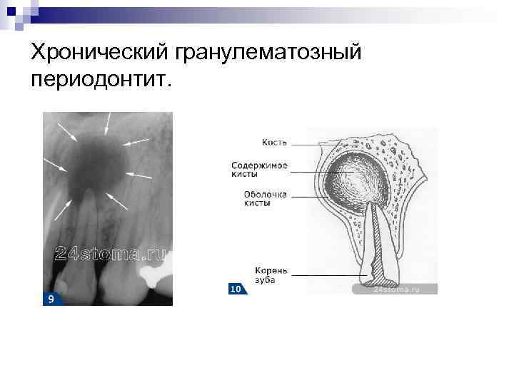 Хронический фиброзный периодонтит мкб. Гранулематозный периодонтит по мкб 10. Классификация верхушечного периодонтита.